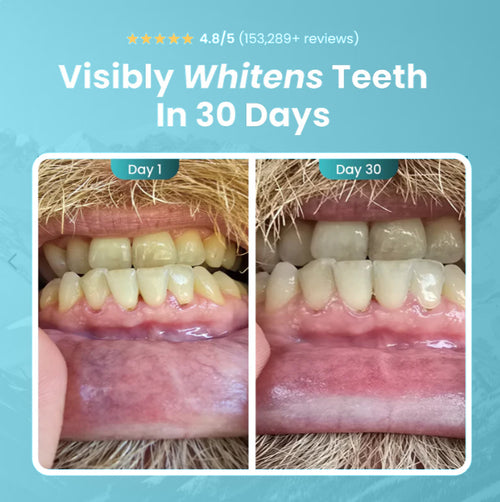 Before and after teeth whitening results showing visibly whiter teeth in 30 days