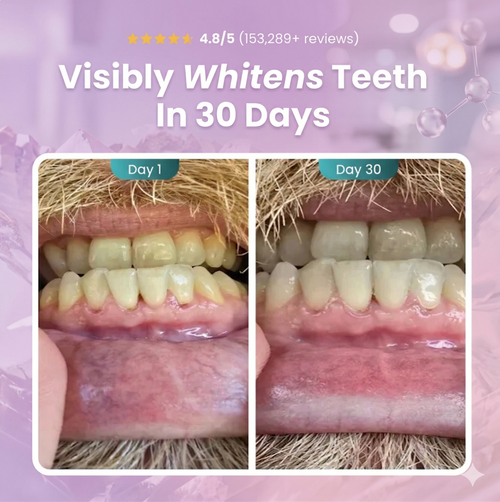 Before and after photo showing teeth whitening results in 30 days, close-up mouth comparison.