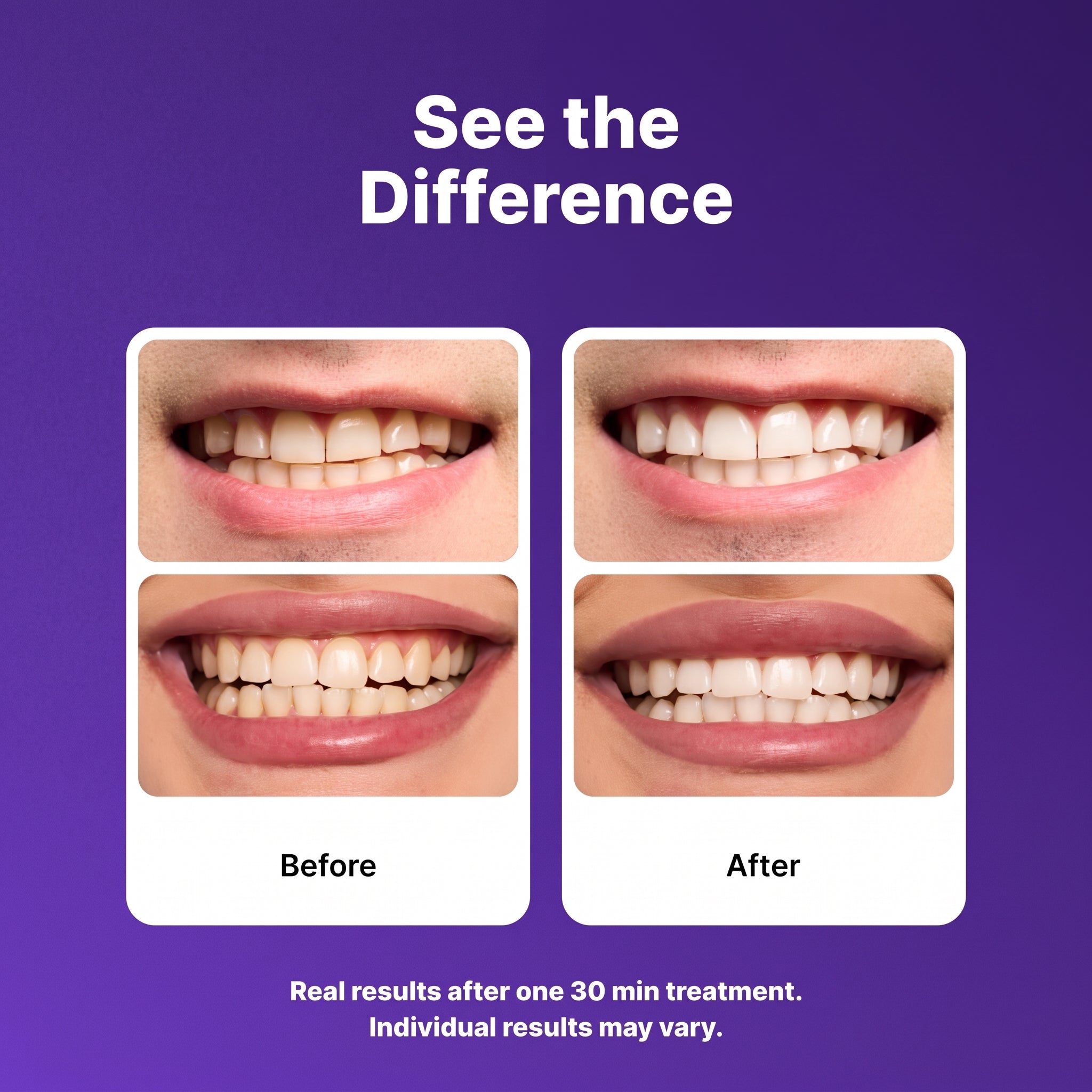 Purple Teeth Whitening Strips – Non-Sensitive Enamel-Safe Whitening