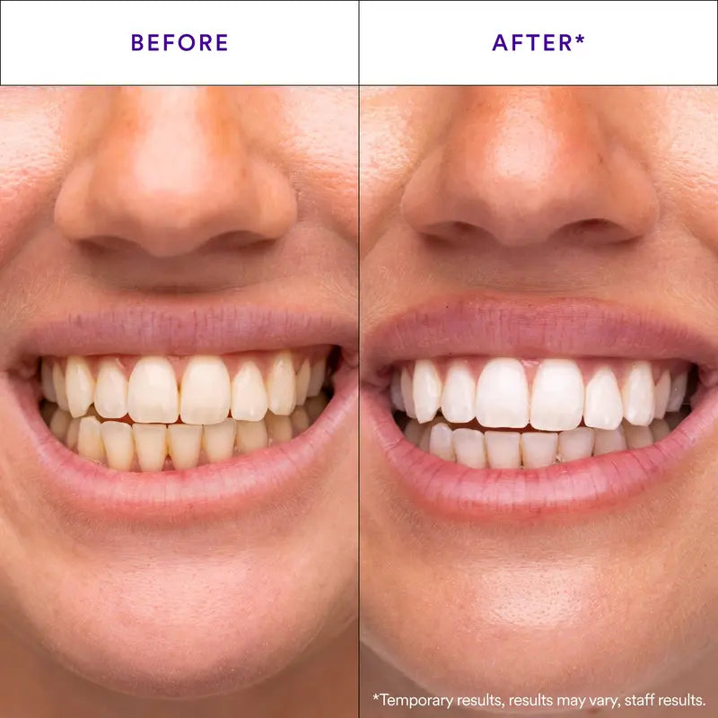 Whitening Strips, Teeth Whitening Strips, Purple Tooth Whitening, Combining Whitening and Colour Correction