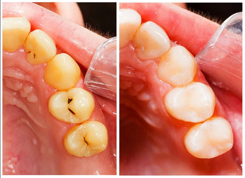 Chewing gum for tooth restoration, gum protection and teeth whitening